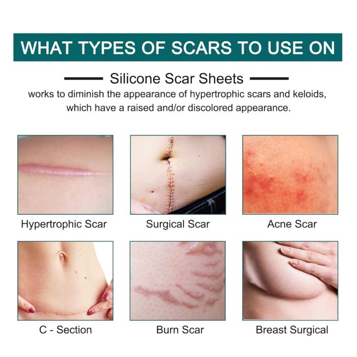 Silicone Scar Sheets (1.6” x 120” Roll-3M), Silicone Scar Tape Roll, Scar Silicone Strips, Reusable, Professional Scar Removal Sheets for C-Section, Surgery, Burn, Keloid, Acne et - Image 2